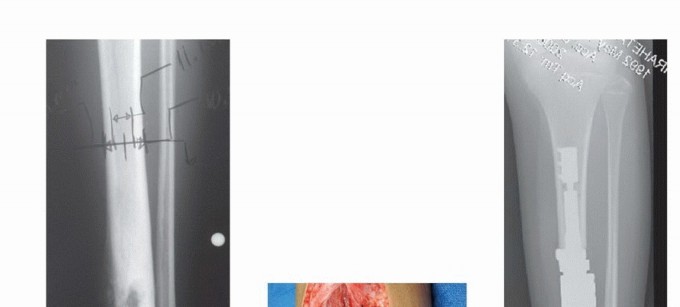 Illustration 26 for Distal Femoral Replacement: Key to Modern Limb Salvage