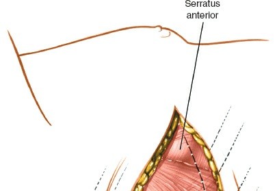Illustration 310 for Approach to the Lumbar Spine: Mastering Techniques & Anatomy