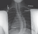 Illustration 5 for Mastering Anterior Interbody Arthrodesis with Instrumentation for Scoliosis