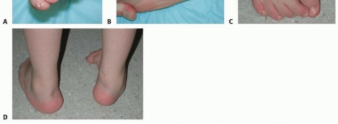 Illustration 8 for Why Anterior Tibialis Muscle Transfer Fixes Clubfoot