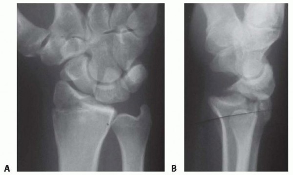 Arthroscopic Reduction and Fixation of Distal Radius and Ulnar Styloid Fractures