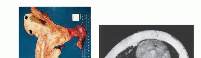 Illustration 22 for Posterior Flap Hemipelvectomy: Mastering Techniques for Optimal Outcomes