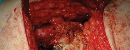 Illustration 8 for Femoral Stem Revision: Posterior Approach for Better Outcomes