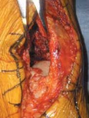 Illustration 44 for Optimizing ORIF for Tibial Plafond Fractures: A Modern Approach