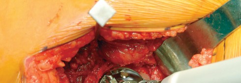 Illustration 56 for Direct Lateral Hip: Optimize Exposure with Sharp Curved Hohmann