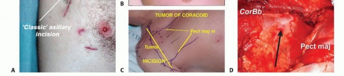 Illustration 13 for Axillary Space Exploration: Surgical Resection of Complex Tumors