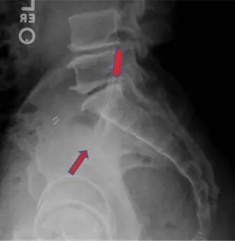 صورة توضيحية لـ إصابات حلقة الحوض من النوع الثاني (APC II): دليل شامل للمرضى من التشخيص إلى التعافي مع الأستاذ الدكتور محمد هطيف
