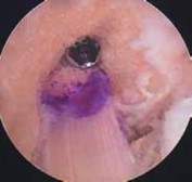 Illustration 75 for Optimizing Single-Bundle Anterior Cruciate Ligament Repair