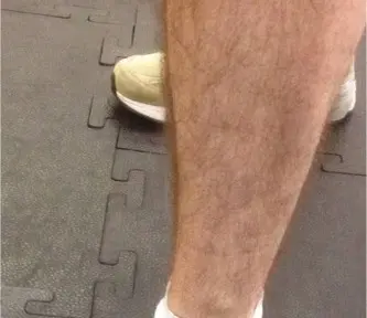 صورة توضيحية لـ متلازمة الحيز الخلفي العميق الجهدي المزمن: دليل شامل للتشخيص والعلاج مع الأستاذ الدكتور محمد هطيف