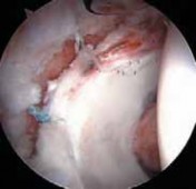 Illustration 21 for Resolving Femoral Head Neck Impingement: Arthroscopic FAI Solutions