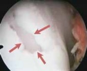 Illustration 2 for Microfracture Chondroplasty: How Tiny Holes Are Made to Fix Cartilage