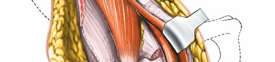 Illustration 45 for Unlocking Every Aspect of the Hip's Surgical Approaches