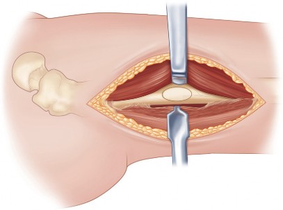 Illustration 52 for Femoral Stem Revision: Posterior Approach for Better Outcomes