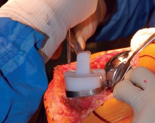 Illustration 62 for Mastering Gap Balancing in Revision TKA: Avoid Common Pitfalls