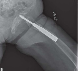 Illustration 10 for THA for patients with proximal femoral deformity: Practical solutions