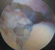 Illustration 27 for Resolving Femoral Head Neck Impingement: Arthroscopic FAI Solutions