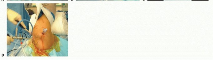 Illustration 15 for Regain Stability: Arthroscopy for Anterior Instability & the Inferior Glenohumeral Ligament