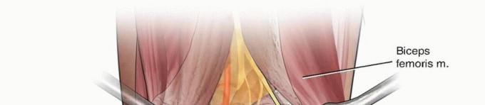 Mastering Posterior Plateau Fractures via Direct Posterior Approaches