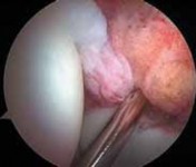 Illustration 40 for Solving Hip Soft Tissue Pathology with Advanced Arthroscopy