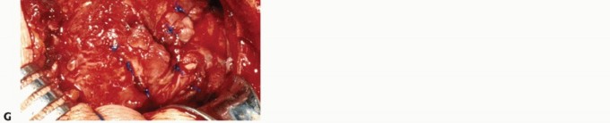 Illustration 30 for Subscapularis & Teres Rotator Cuff Repair: Advanced Techniques