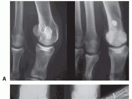 Illustration 31 for Mastering the Biplanar Distal Chevron for Effective Bunion Surgery