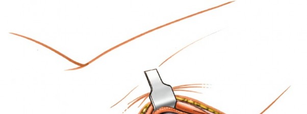 Illustration 97 for Mastering Elbow Approaches: Applied Surgical Anatomy for Precision