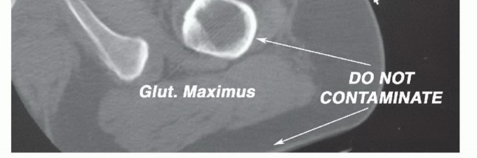 Illustration 9 for Posterior Flap Hemipelvectomy: Mastering Techniques for Optimal Outcomes
