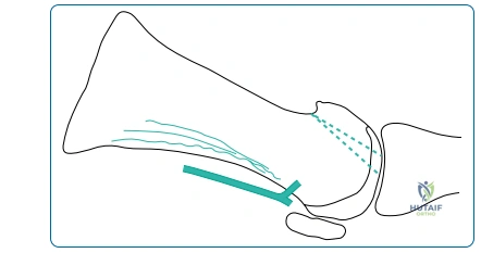 First Metatarsophalangeal Joint Surgery: Understanding Your Options
