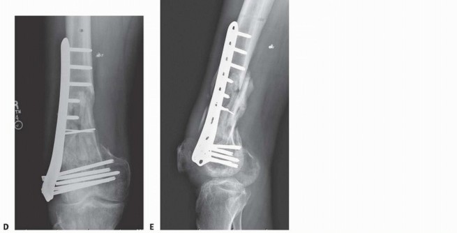 Illustration 75 for Repairing Distal Femur Fractures: Open Reduction & Internal Fixation