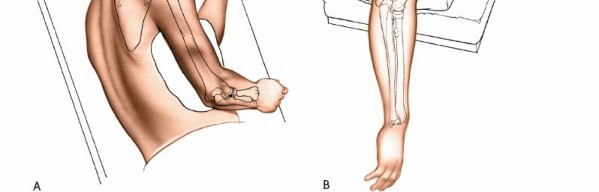 Illustration 32 for Mastering the Approach to the Distal Humerus: Safety & Skills