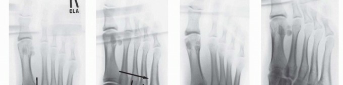 Illustration 6 for Fixation of Lisfranc Injuries: Essential Open Reduction Guide