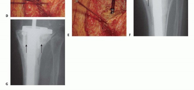 Illustration 14 for Bone Loss Bone Grafting for Challenging Tibial Defects