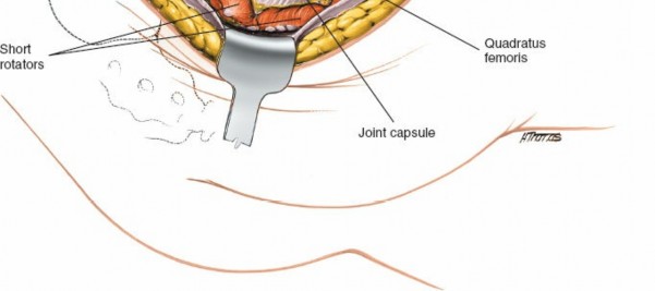 Illustration 12 for Acetabulum Posterior Approach: Simplest Fix for Hip Fractures