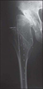 Illustration 121 for Successful Total Hip Replacement in Developmental Dysplasia