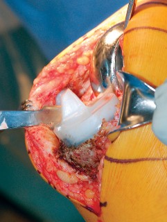 Illustration 15 for Mastering Gap Balancing in Revision TKA: Avoid Common Pitfalls