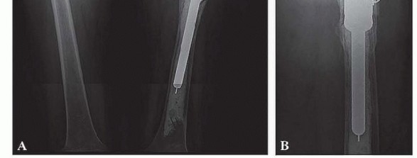 Illustration 3 for Limb Salvage: New Advances in Proximal Femoral Replacement