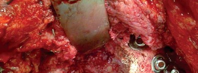 Illustration 26 for Management of Periprosthetic Fractures: An Expert Surgical Guide