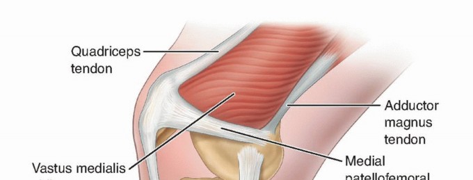 End Patellar Dislocation: Patellofemoral Ligament Reconstruction
