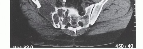 Illustration 9 for Surgical Pelvic Resection: Gluteus Maximus Muscle & Nerve Preservation
