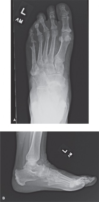 Diagnosing hindfoot pain: When it's not tibial tendon dysfunction