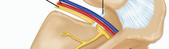 Illustration 2 for Decompressing the Transverse Scapular Ligament for Shoulder Pain Relief