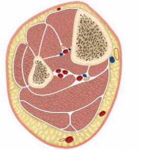 Illustration of compartment syndrome chronic exertional - Dr. Mohammed Hutaif