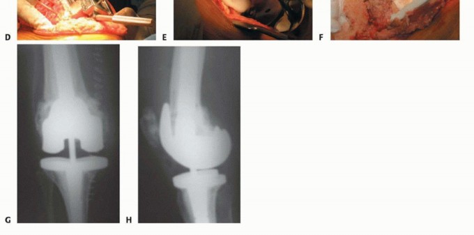 Illustration 16 for Femoral Bone Loss: Metal Augments for Revision Knee Success