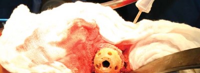 Illustration 71 for Metal on Metal Resurfacing: Enhanced Posterior Soft Tissue Repair