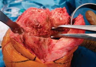 Illustration 27 for Precision Soft Tissue Balancing in Revision: Avoid TKA Pitfalls