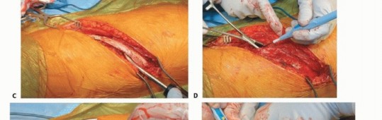 Illustration 25 for Anterior Interbody Arthrodesis for Scoliosis: What You Need to Know