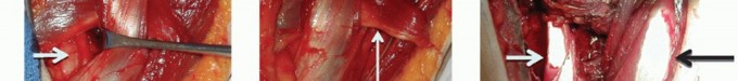 Illustration 13 for Irreparable Subscapularis Tears? Explore Pectoralis Major Transfer.