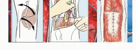 Illustration 20 for Optimizing Resection: An Overview of Surgical Approaches for Space Sarcomas