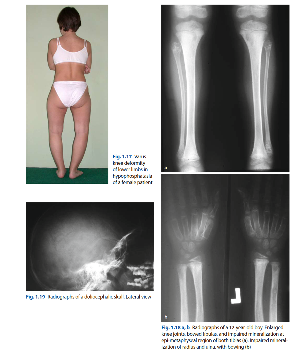 Orthopedic Cases Hypophosphatasia: Expert Insights & Management