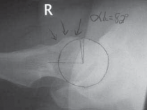 Illustration 5 for Resolving Femoral Head Neck Impingement: Arthroscopic FAI Solutions